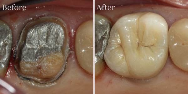 Dental crown result — Southwater Dental Practice