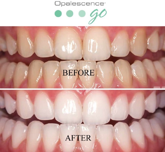 Teeth Whitening treatment at Southwater Dental Practice