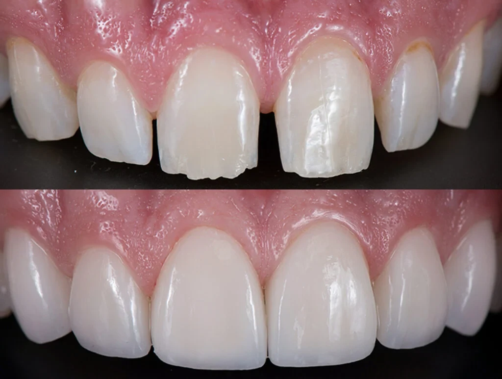 Veneers treatment at Southwater Dental Practice