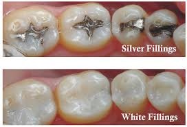 White Fillings treatment at Southwater Dental Practice